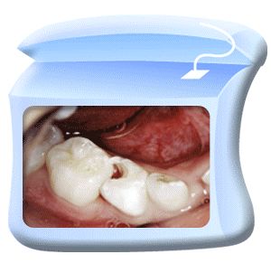 口腔百科丨蛀牙的战争：看你“氟”不“氟”