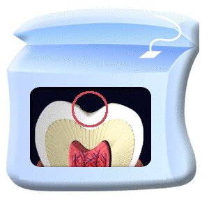 口腔百科丨蛀牙的战争：看你“氟”不“氟”