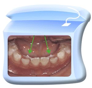 换牙不怂丨丑小鸭期的牙齿怎么护理？