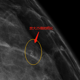 乳腺机为什么叫钼靶【精准医学】马村区人民医院引进焦作东部城区首台乳腺钼靶机----让乳腺疾病无处可藏_https://www.jmylbn.com_新闻资讯_第16张