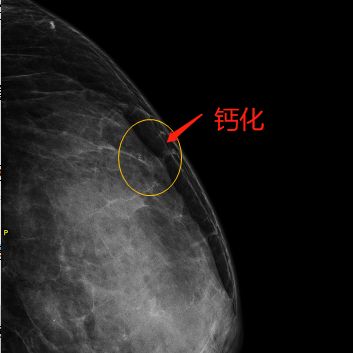乳腺机为什么叫钼靶【精准医学】马村区人民医院引进焦作东部城区首台乳腺钼靶机----让乳腺疾病无处可藏_https://www.jmylbn.com_新闻资讯_第15张