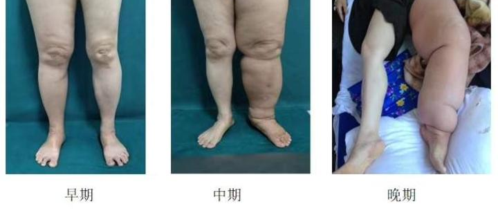 压力绷带为什么那么贵警惕这种“肿”！不敢乱运动！_https://www.jmylbn.com_新闻资讯_第4张