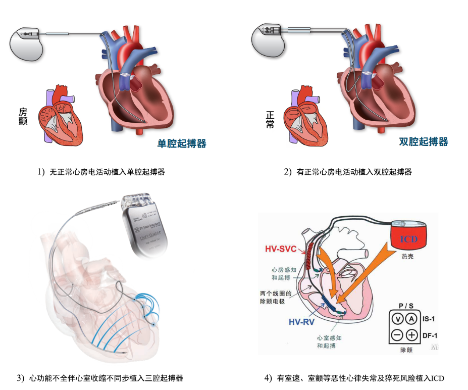 “快慢综合征”与“慢快综合征”的区别与联系