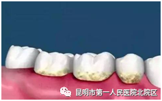 喷砂洁牙机怎么打开【甘美科普】喷砂洁牙，你知道吗？_https://www.jmylbn.com_新闻资讯_第3张