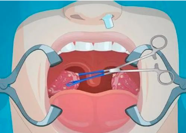 外科胶带怎么撕暑假到了，耳鼻喉科和泌尿外科又要掀起一轮手术狂潮！腺样体／扁桃体切除手术，你家孩子真的需要做吗？_https://www.jmylbn.com_新闻资讯_第33张