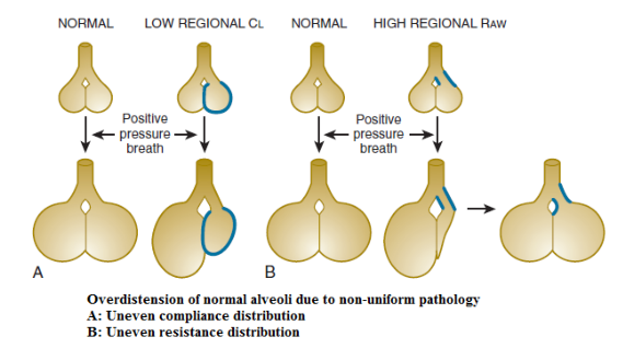 呼吸机数值怎么认不同疾病状态下的呼吸机设置_https://www.jmylbn.com_新闻资讯_第5张