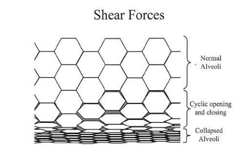 呼吸机数值怎么认不同疾病状态下的呼吸机设置_https://www.jmylbn.com_新闻资讯_第2张