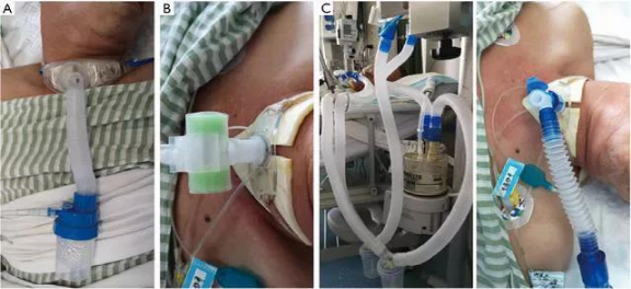 热湿装置怎么安装＜转载＞如何给气管切开患者选择合适的湿化装置？_https://www.jmylbn.com_新闻资讯_第14张