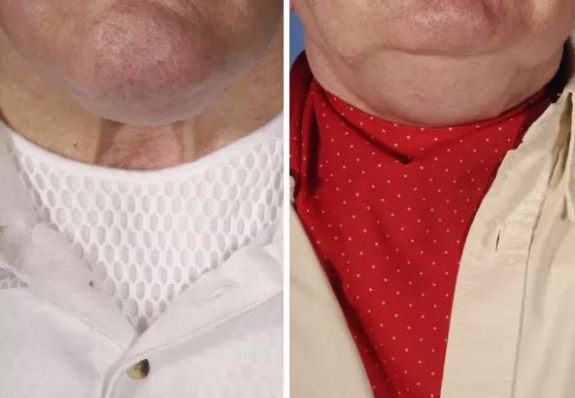 热湿装置怎么安装＜转载＞如何给气管切开患者选择合适的湿化装置？_https://www.jmylbn.com_新闻资讯_第5张