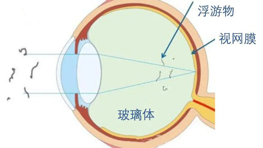 因为飞蚊症造成的事故