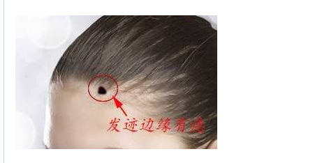 头发边缘有痣代表什么，发际线上有痣命运如何