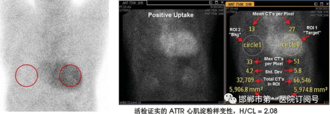 d-spect怎么检查我院核医学科率先开展99mTc-PYP心脏淀粉样变SPECT／CT显像_https://www.jmylbn.com_新闻资讯_第8张