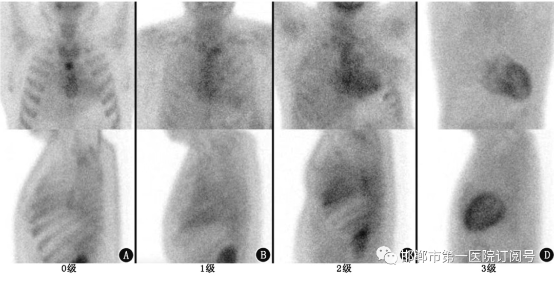 d-spect怎么检查我院核医学科率先开展99mTc-PYP心脏淀粉样变SPECT／CT显像_https://www.jmylbn.com_新闻资讯_第7张