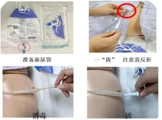 尿管怎么固定尿管的居家护理_https://www.jmylbn.com_新闻资讯_第7张