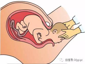 当小宝宝娩出母体之后,孕妈妈就进入第三产程,也就是胎盘,胎膜娩出的