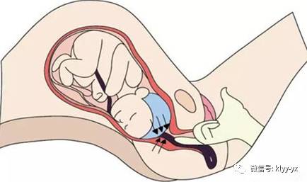 分娩时胎儿的必经之地,决定你的分娩方式