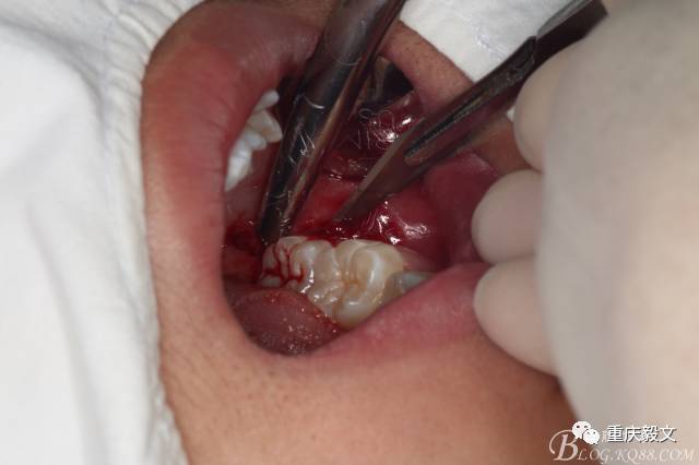 教材版的下颌埋伏智齿的拔除