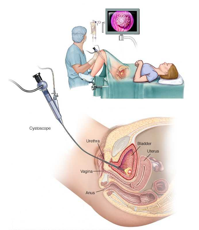b膀胱镜为什么消毒你关于膀胱镜你知道多少？_https://www.jmylbn.com_新闻资讯_第3张