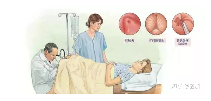 b膀胱镜为什么消毒你关于膀胱镜你知道多少？_https://www.jmylbn.com_新闻资讯_第4张