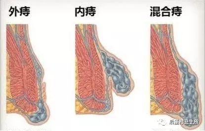 痔u201d在必除为您解除u201c难言之隐u201d - 后堡村卫生所 微信公众号文章阅读- WeMP