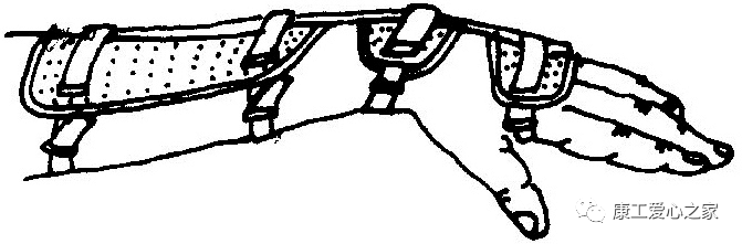 下肢关节康复器怎么用康复科普｜腕手矫形器在工伤康复中的应用_https://www.jmylbn.com_新闻资讯_第16张