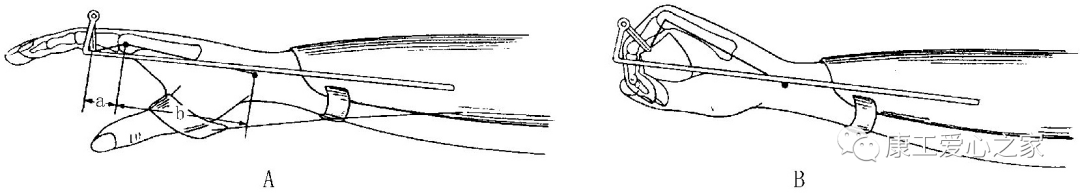下肢关节康复器怎么用康复科普｜腕手矫形器在工伤康复中的应用_https://www.jmylbn.com_新闻资讯_第20张