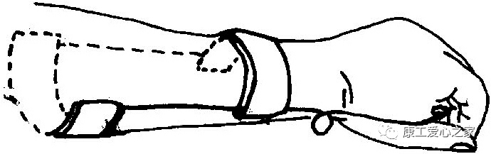 下肢关节康复器怎么用康复科普｜腕手矫形器在工伤康复中的应用_https://www.jmylbn.com_新闻资讯_第18张