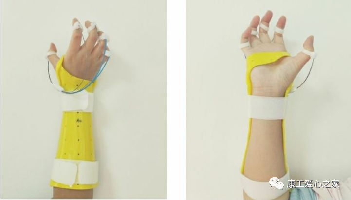 下肢关节康复器怎么用康复科普｜腕手矫形器在工伤康复中的应用_https://www.jmylbn.com_新闻资讯_第7张