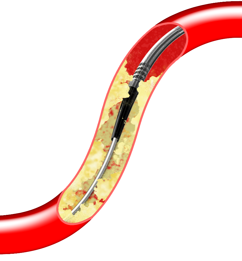 为什么要用到微导管无微不至，游刃有余的微导管_https://www.jmylbn.com_新闻资讯_第17张