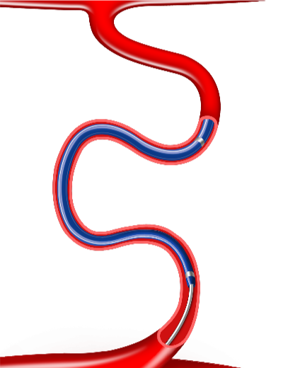 为什么要用到微导管无微不至，游刃有余的微导管_https://www.jmylbn.com_新闻资讯_第12张