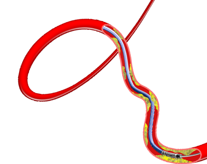 为什么要用到微导管无微不至，游刃有余的微导管_https://www.jmylbn.com_新闻资讯_第5张