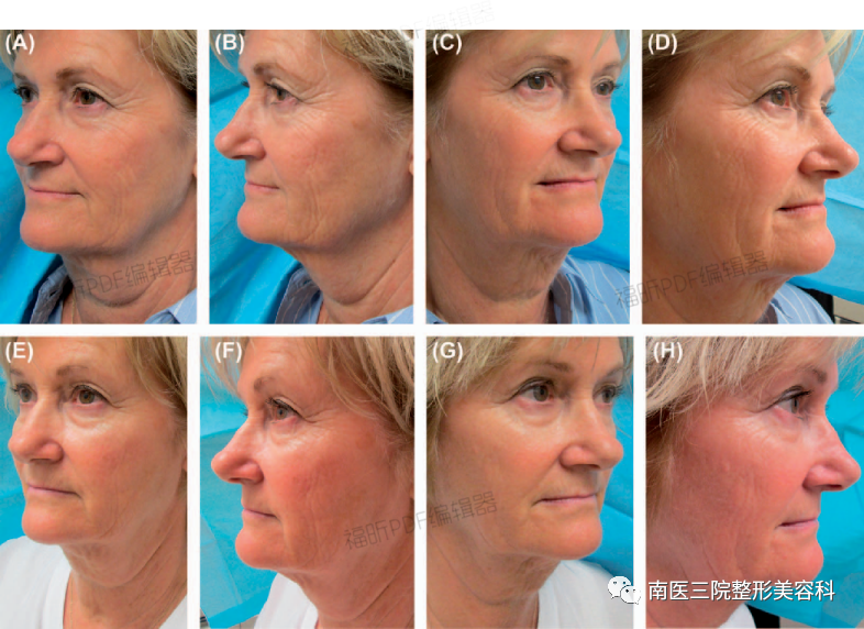 双极射频是什么转载：临床报告：一种用于面部和颈部皮肤紧致的新型无创射频皮肤加热装置_https://www.jmylbn.com_新闻资讯_第5张