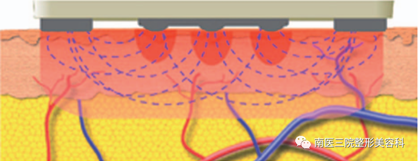 双极射频是什么转载：临床报告：一种用于面部和颈部皮肤紧致的新型无创射频皮肤加热装置_https://www.jmylbn.com_新闻资讯_第2张