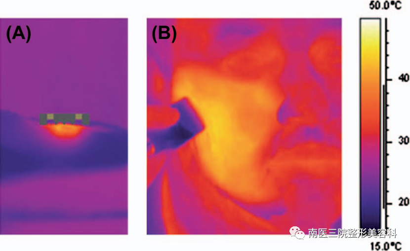 双极射频是什么转载：临床报告：一种用于面部和颈部皮肤紧致的新型无创射频皮肤加热装置_https://www.jmylbn.com_新闻资讯_第3张
