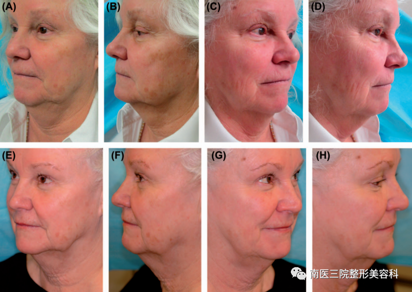 双极射频是什么转载：临床报告：一种用于面部和颈部皮肤紧致的新型无创射频皮肤加热装置_https://www.jmylbn.com_新闻资讯_第4张