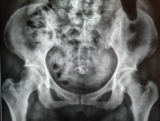 悬吊DR怎么安装放射科再添“利器”｜我院引进一台悬吊式无线双板电动DR拍片设备_https://www.jmylbn.com_新闻资讯_第7张