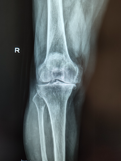 悬吊DR怎么安装放射科再添“利器”｜我院引进一台悬吊式无线双板电动DR拍片设备_https://www.jmylbn.com_新闻资讯_第10张