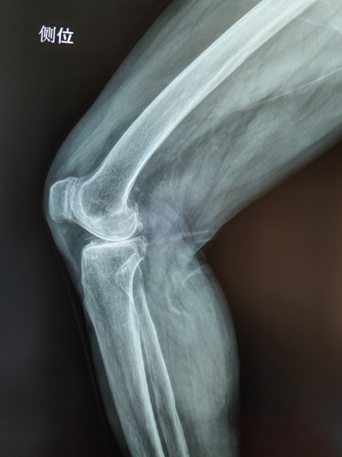 悬吊DR怎么安装放射科再添“利器”｜我院引进一台悬吊式无线双板电动DR拍片设备_https://www.jmylbn.com_新闻资讯_第9张