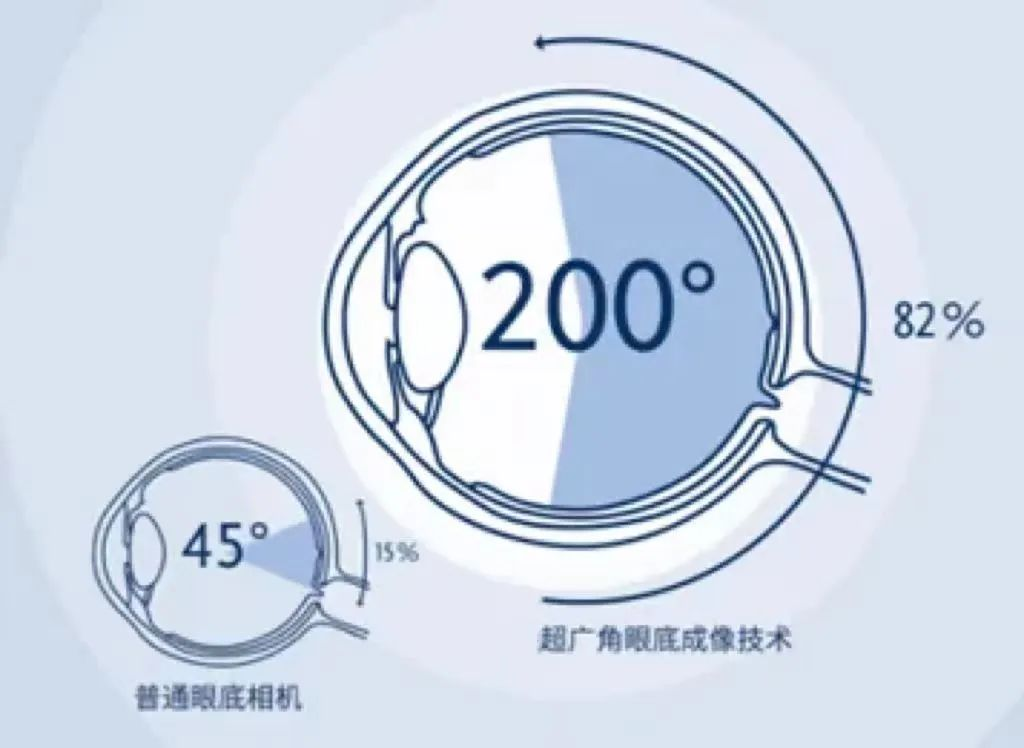 怎么看眼底相机【眼科新设备】超广角眼底照相机——眼底病诊断排查“神器”_https://www.jmylbn.com_新闻资讯_第2张