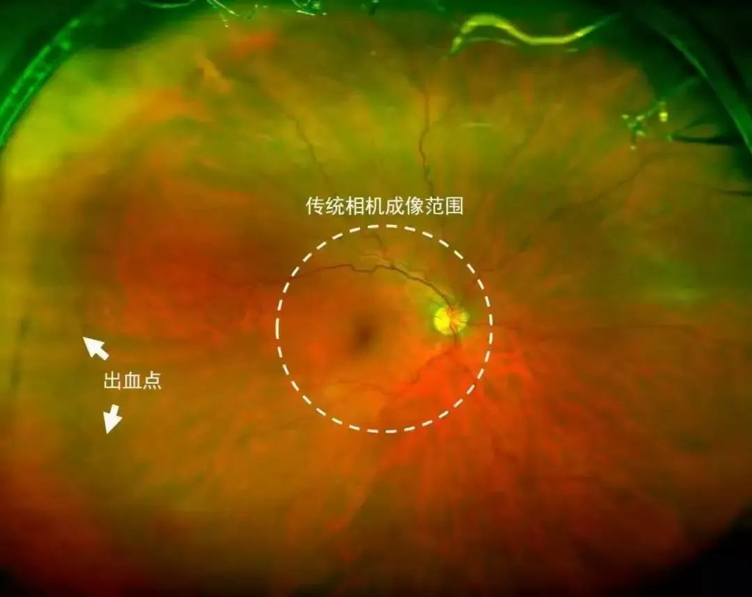 怎么看眼底相机【眼科新设备】超广角眼底照相机——眼底病诊断排查“神器”_https://www.jmylbn.com_新闻资讯_第3张
