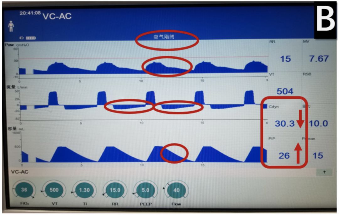 吸痰装置怎么连接【诊疗方案】新型冠状病毒感染重型及危重型患者呼吸治疗相关操作防护措施专家共识_https://www.jmylbn.com_新闻资讯_第12张