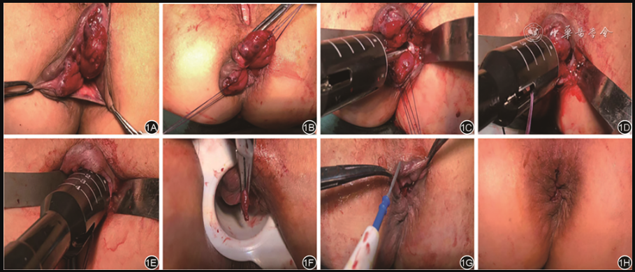 痔疮吻合钉长什么样【论著】吻合器痔上黏膜适形切除钉合术治疗Ⅲ~Ⅳ度环状混合痔的临床疗效分析_https://www.jmylbn.com_新闻资讯_第1张