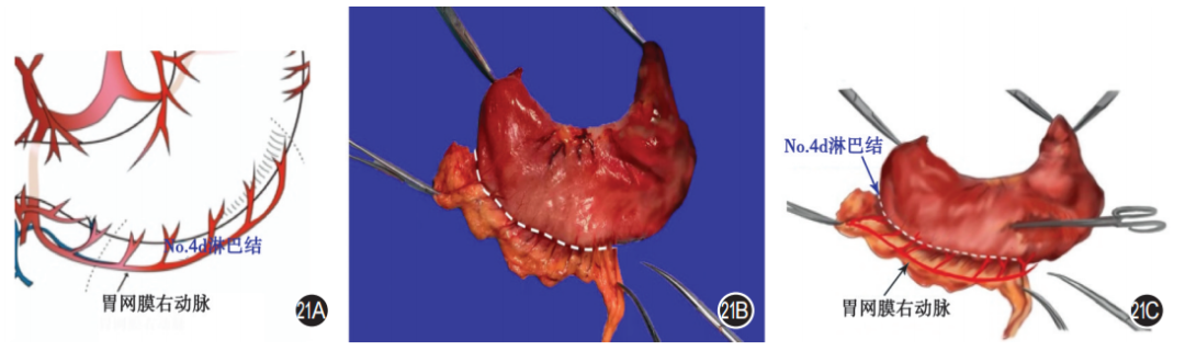 大体标本是什么【指南与共识】胃癌根治术标本的规范化外科处理中国专家共识（2022版）_https://www.jmylbn.com_新闻资讯_第21张