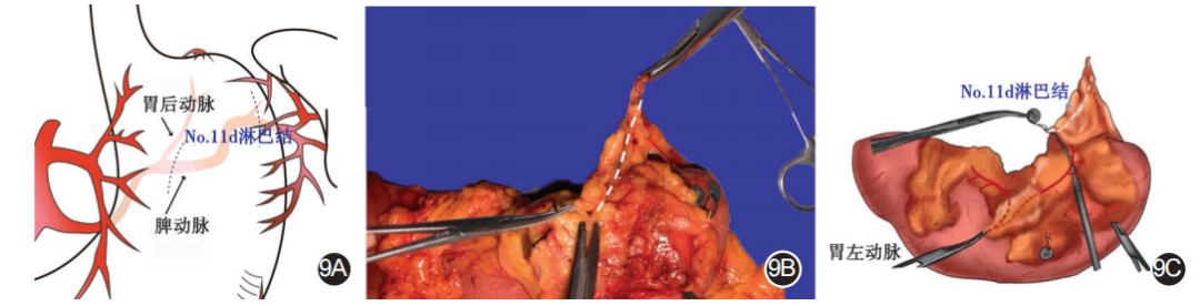 大体标本是什么【指南与共识】胃癌根治术标本的规范化外科处理中国专家共识（2022版）_https://www.jmylbn.com_新闻资讯_第9张