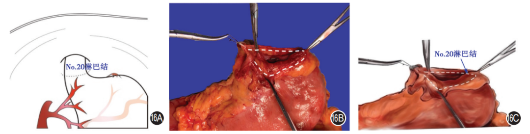 大体标本是什么【指南与共识】胃癌根治术标本的规范化外科处理中国专家共识（2022版）_https://www.jmylbn.com_新闻资讯_第16张