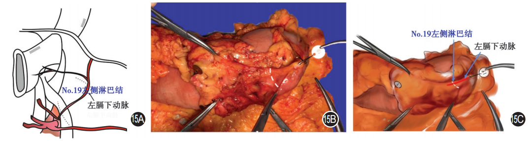 大体标本是什么【指南与共识】胃癌根治术标本的规范化外科处理中国专家共识（2022版）_https://www.jmylbn.com_新闻资讯_第15张