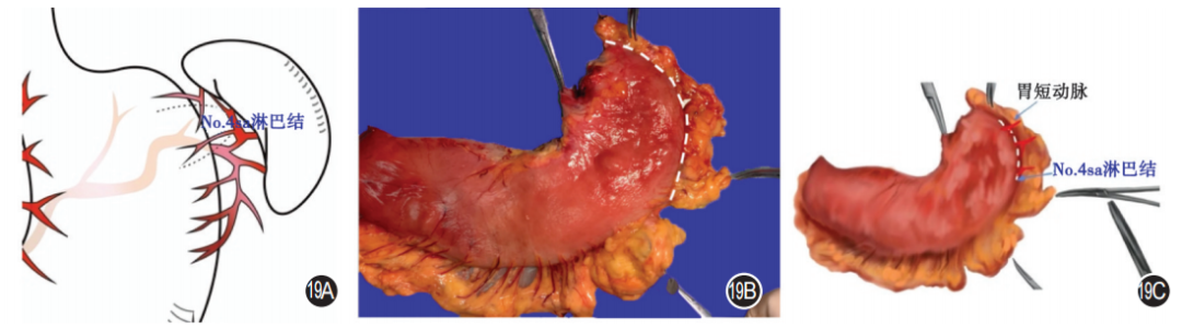 大体标本是什么【指南与共识】胃癌根治术标本的规范化外科处理中国专家共识（2022版）_https://www.jmylbn.com_新闻资讯_第19张
