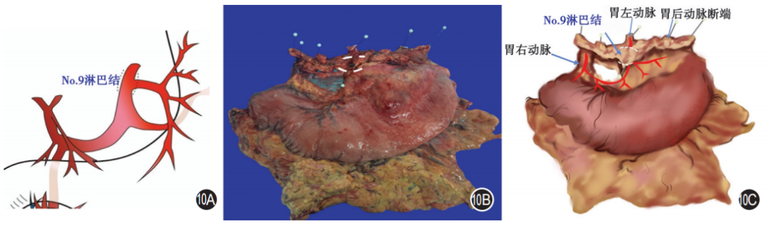 大体标本是什么【指南与共识】胃癌根治术标本的规范化外科处理中国专家共识（2022版）_https://www.jmylbn.com_新闻资讯_第10张