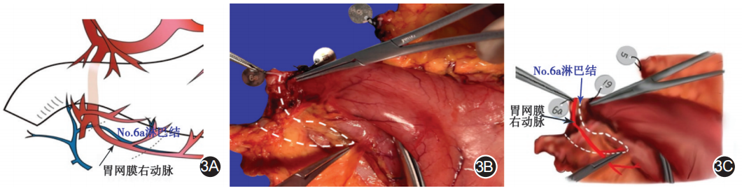 大体标本是什么【指南与共识】胃癌根治术标本的规范化外科处理中国专家共识（2022版）_https://www.jmylbn.com_新闻资讯_第3张