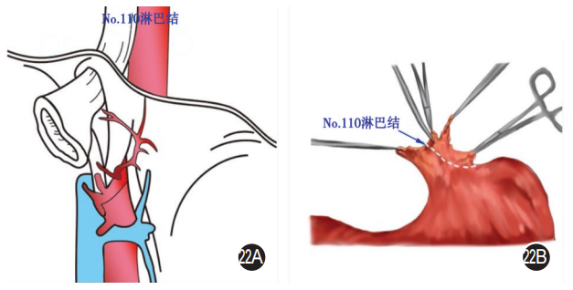 大体标本是什么【指南与共识】胃癌根治术标本的规范化外科处理中国专家共识（2022版）_https://www.jmylbn.com_新闻资讯_第22张